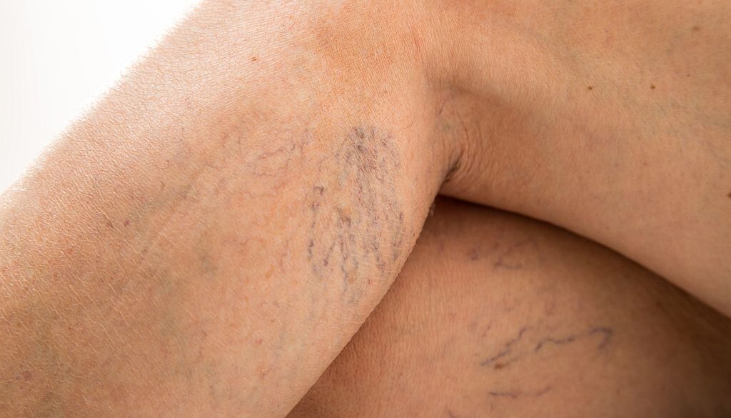 Skleroterapia – jak działa i kiedy warto się na nią zdecydować?