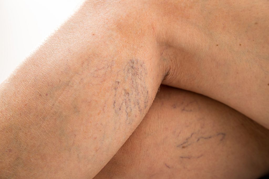 Skleroterapia – jak działa i kiedy warto się na nią zdecydować?