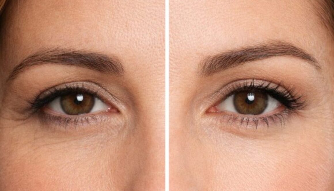 Brow lift a opadające brwi