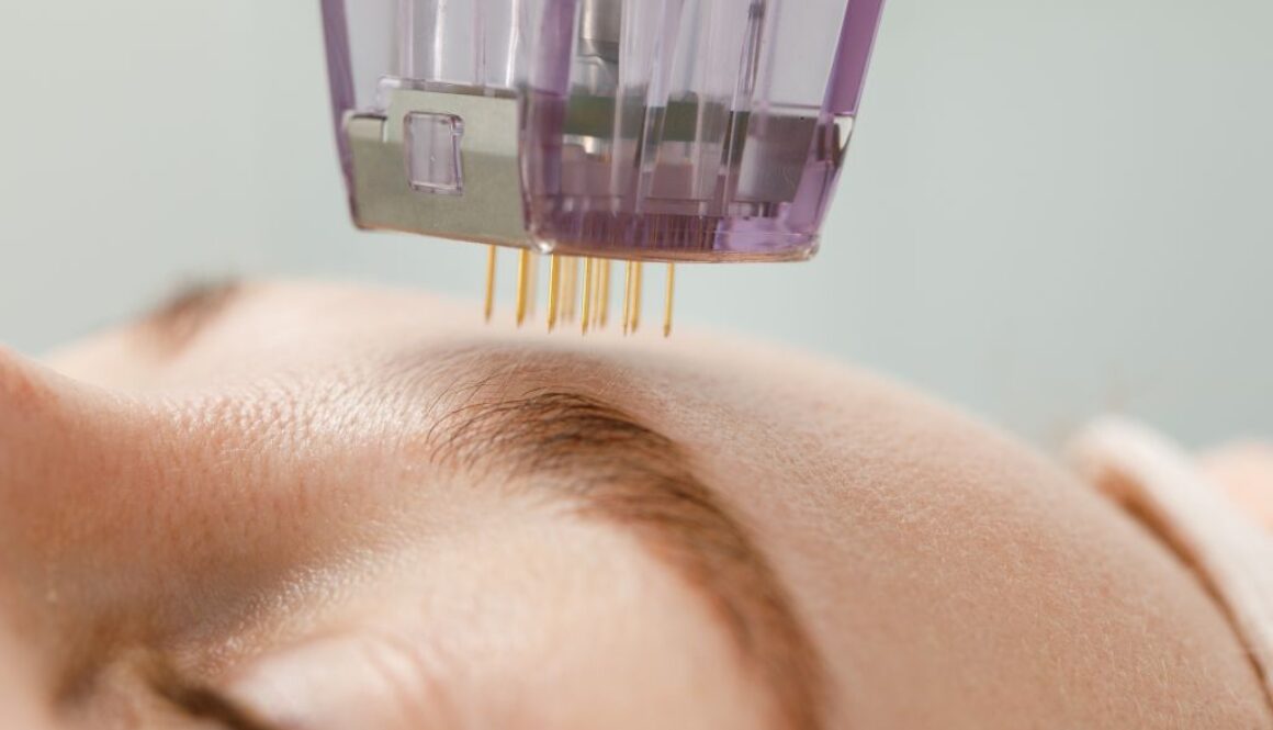 Jakie problemy skóry można poprawić dzięki radiofrekwencji mikroigłowej